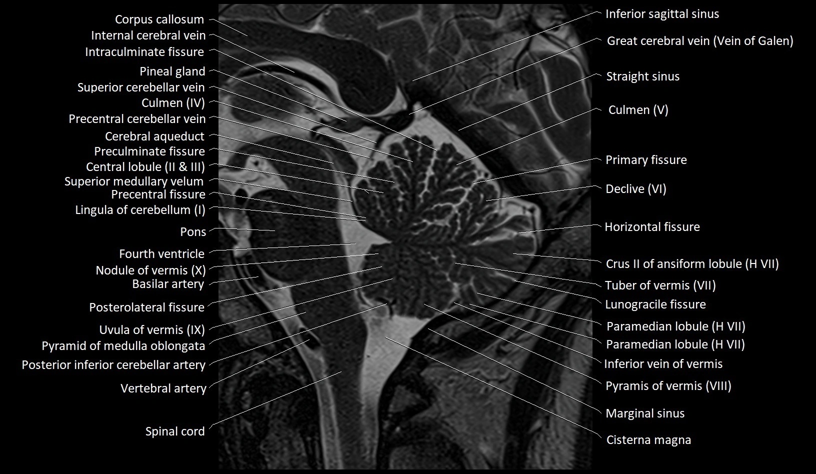 MRI Cerebellar anatomy sagittal High-resolution labelled image 30.webp